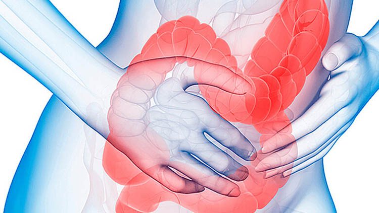 sindrome intestino irritavel