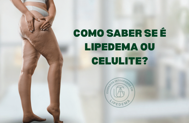 Como saber se é lipedema ou celulite: diferenças e sinais importantes